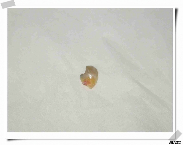 自行拔牙恐怖爆笑劇>.<"(附牙齒遺照)