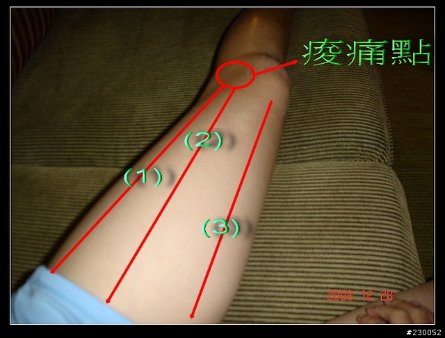 膝蓋痠痛症狀~個人復健過程分享