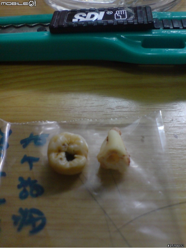 有智齒血肉照之開刀拔除水平智齒&before vs. after照片