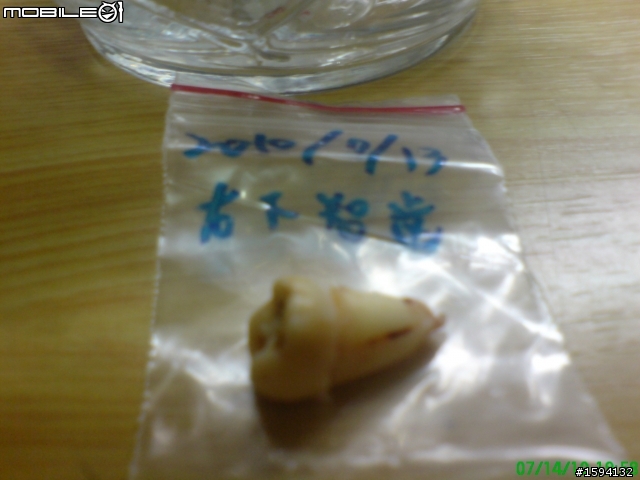 有智齒血肉照之開刀拔除水平智齒&before vs. after照片