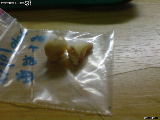有智齒血肉照之開刀拔除水平智齒&before vs. after照片