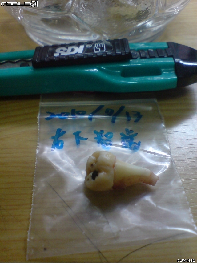 有智齒血肉照之開刀拔除水平智齒&before vs. after照片