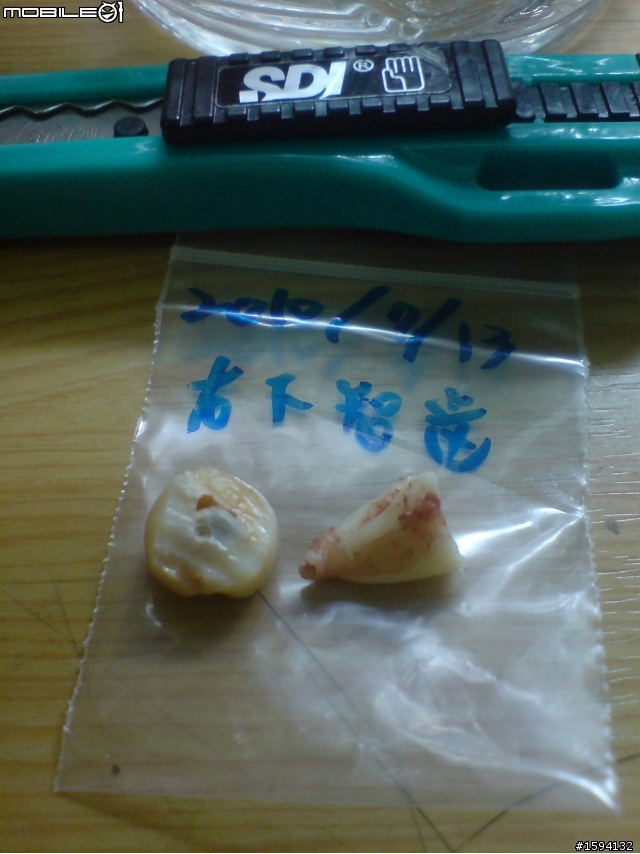 有智齒血肉照之開刀拔除水平智齒&before vs. after照片