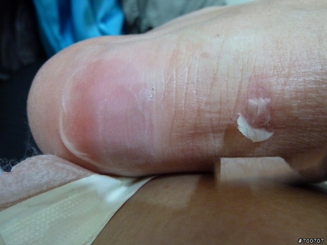 有人穿馬汀鞋變這樣嗎?(圖不甚雅觀,不喜勿入)