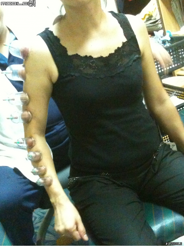 第一次拔罐就上手(?)