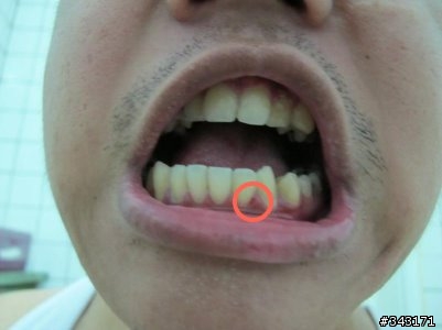 問世間"細絲特磨"為何物?牙齦腫牙菌斑怎麼辦?