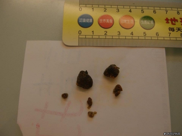 我的膽結石蘋果汁療法(圖很噁心,不喜勿入)