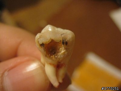 美國拔智齒經驗~文長 (附圖慎入!!)