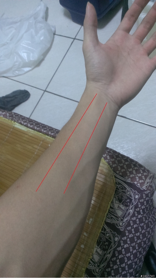 左手臂異常疼痛,是否受傷了 ?