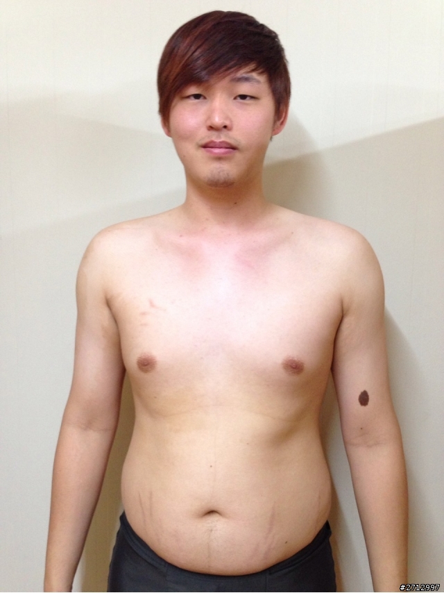 我想和大家分享一個21歲高血壓的故事