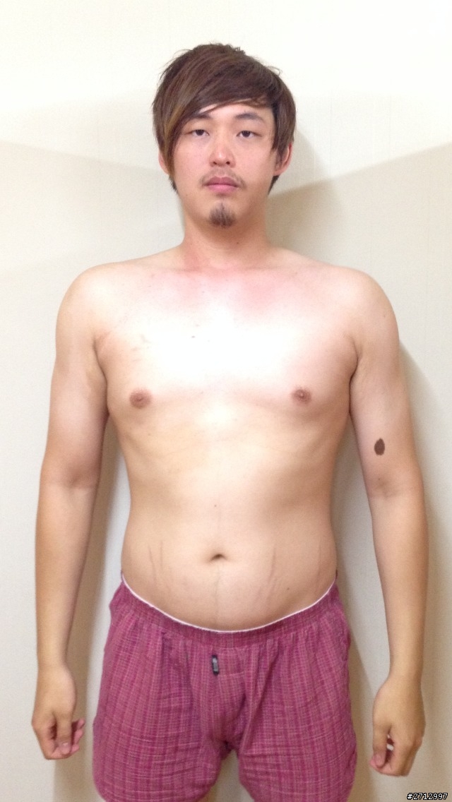 我想和大家分享一個21歲高血壓的故事