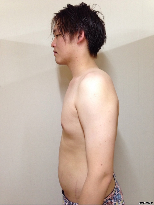 我想和大家分享一個21歲高血壓的故事
