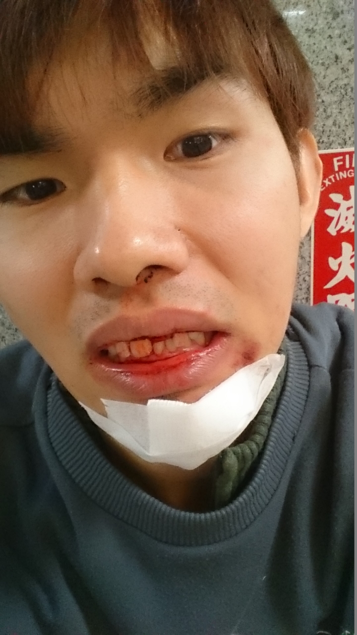 對方轉灣不注意…所以我飛走了…糟糕掉了一根門牙…還有兩顆搖搖欲墜囧