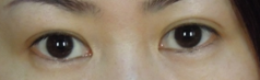 這次是小妹(真的小妹)重修雙眼皮的經驗