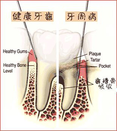 該不該去作牙周再生手術?