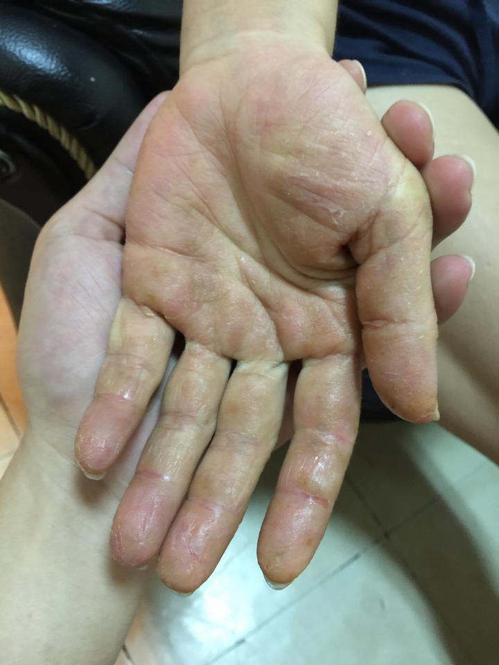 手部疾病(富貴手?求解)