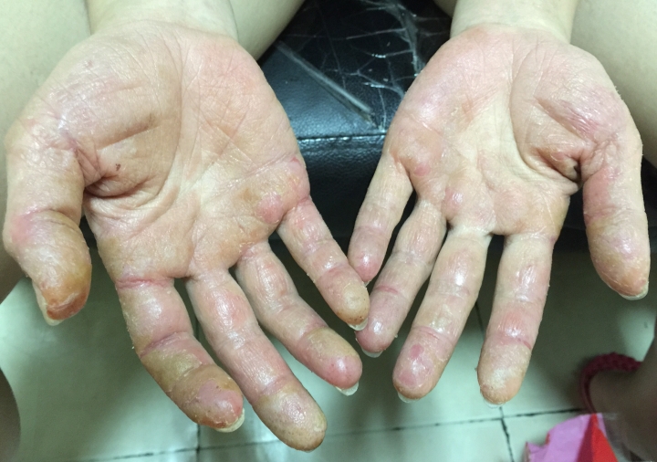 手部疾病(富貴手?求解)