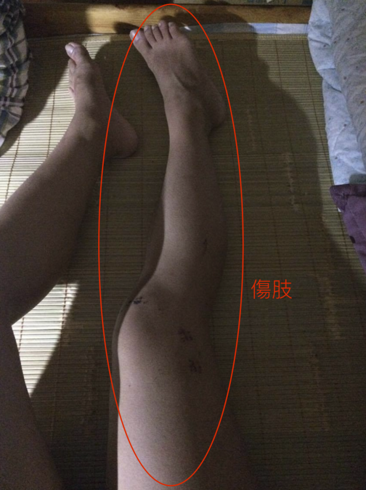 求解:大腿骨折術後復原 疑問