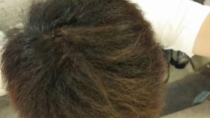 一個以前嚴重掉髮給中醫治療的過程,大家可嚐試中醫(健保)