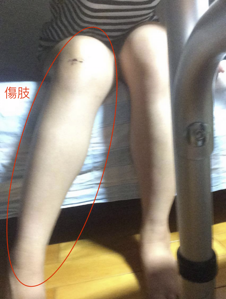 求解:大腿骨折術後復原 疑問
