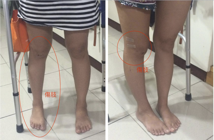 求解:大腿骨折術後復原 疑問