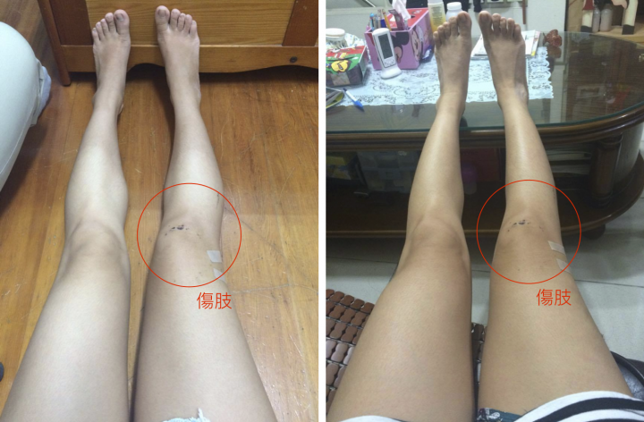 求解:大腿骨折術後復原 疑問