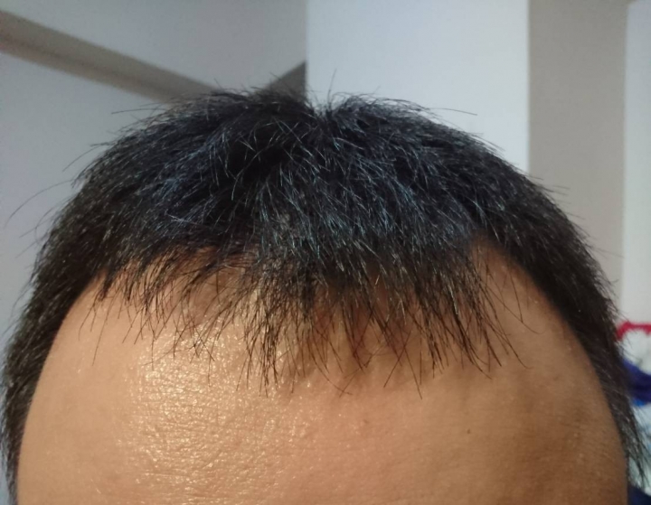 雄性禿養髮經驗分享