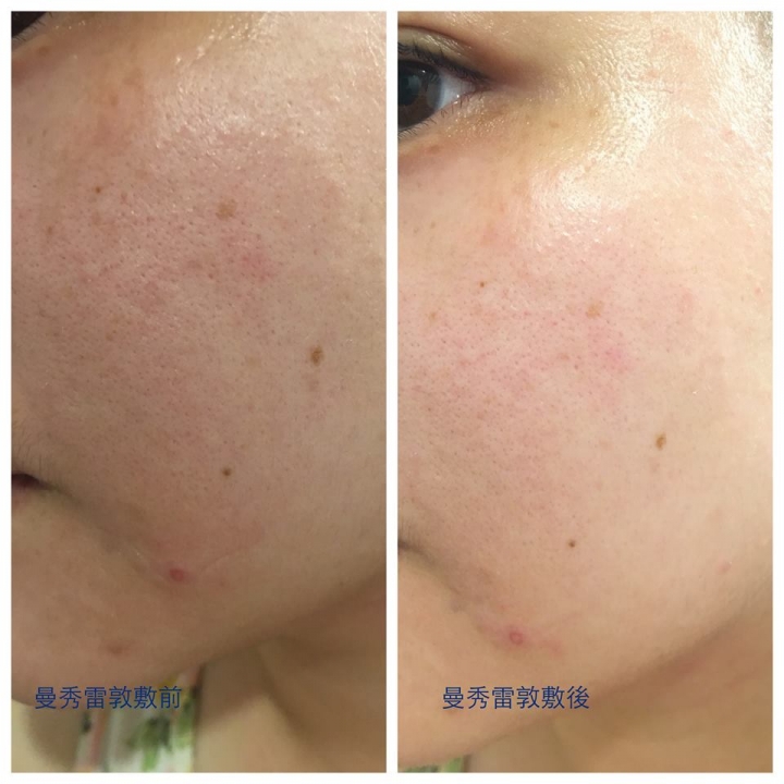兩款消痘水兩頰試用-曼秀雷敦V.S豔容露