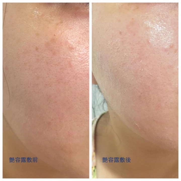兩款消痘水兩頰試用-曼秀雷敦V.S豔容露
