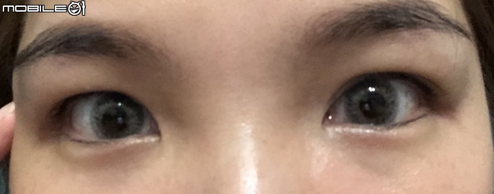 七年前縫完掉了~~重縫雙眼皮分享