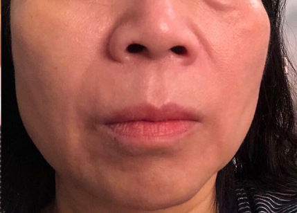 改善法令紋.臉部鬆弛的抗老乳霜