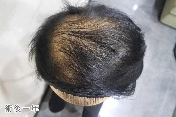植髮心得半年到一年半的成果