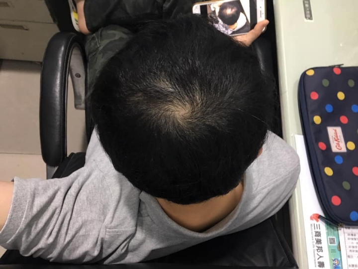 育髮療程