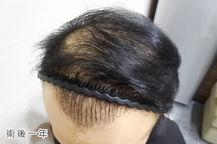 植髮心得半年到一年半的成果