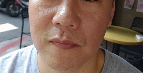第一次打UP雷射,盧靜怡醫師UP雷射分享