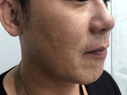 第一次打UP雷射,盧靜怡醫師UP雷射分享