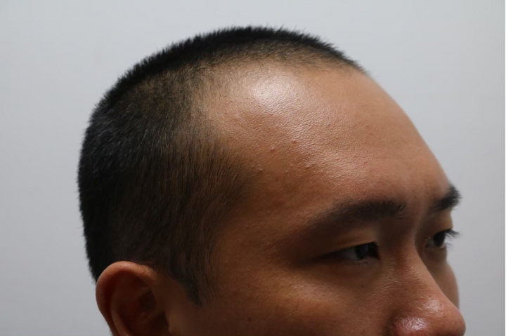 想分享跟記錄個歷程#密集恐懼症的不要看