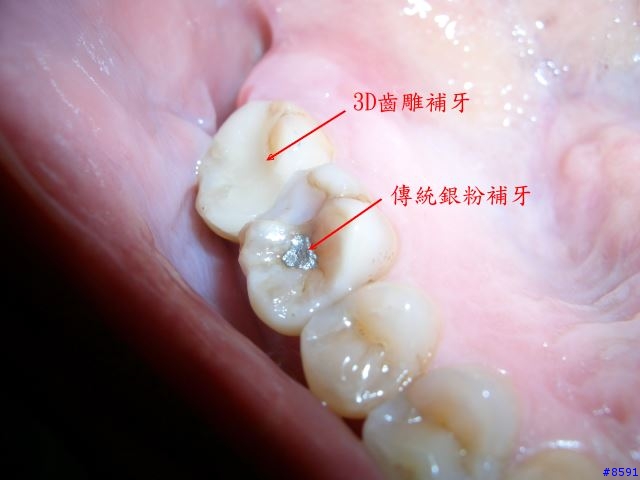[想知道]他們怎麼搞我的牙齒的