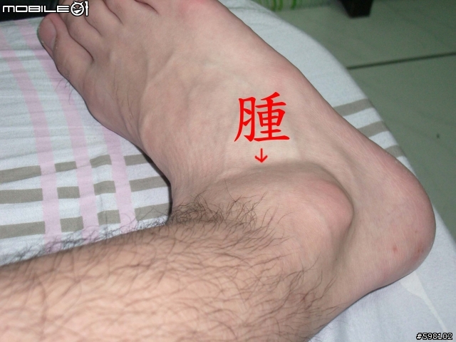 [求助]腳踝腫起來了 有圖有真相 工作完蛋了