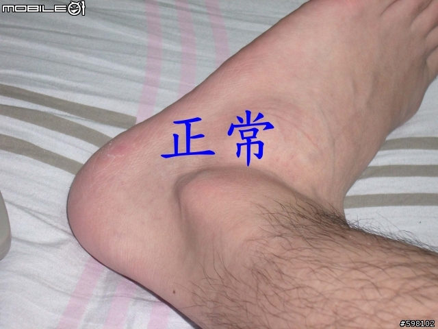 [求助]腳踝腫起來了 有圖有真相 工作完蛋了