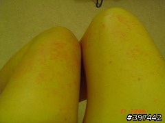 有人跟我一樣身受過敏性蕁麻疹之苦嗎??(有圖,小噁...)