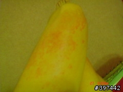 有人跟我一樣身受過敏性蕁麻疹之苦嗎??(有圖,小噁...)