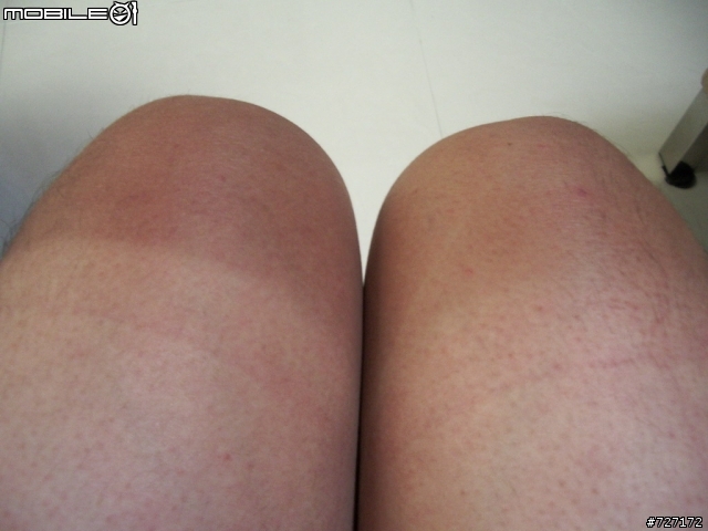 [求救]我的大腿變兩色啦...