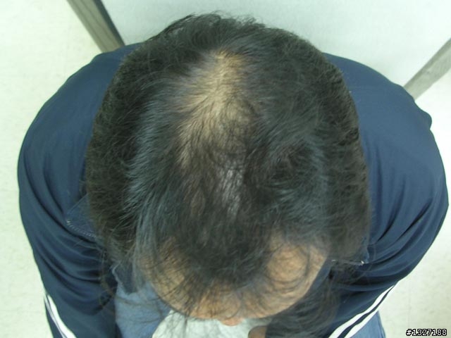 中年男子的生髮紀錄