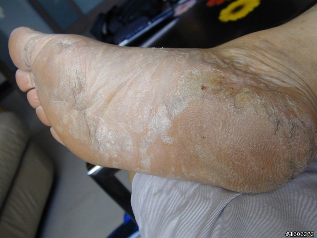 SOS誰能救救我的腳底?腳跟裂!脫皮會癢!有照片(恐佈喔!)