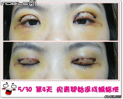 [分享]割雙眼皮全紀錄