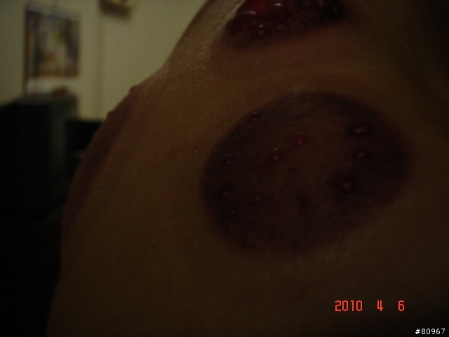 拔罐, 要注意時間.....