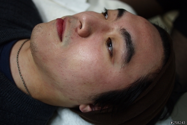 【西西分享】我也去飛梭雷射了---飛輪光