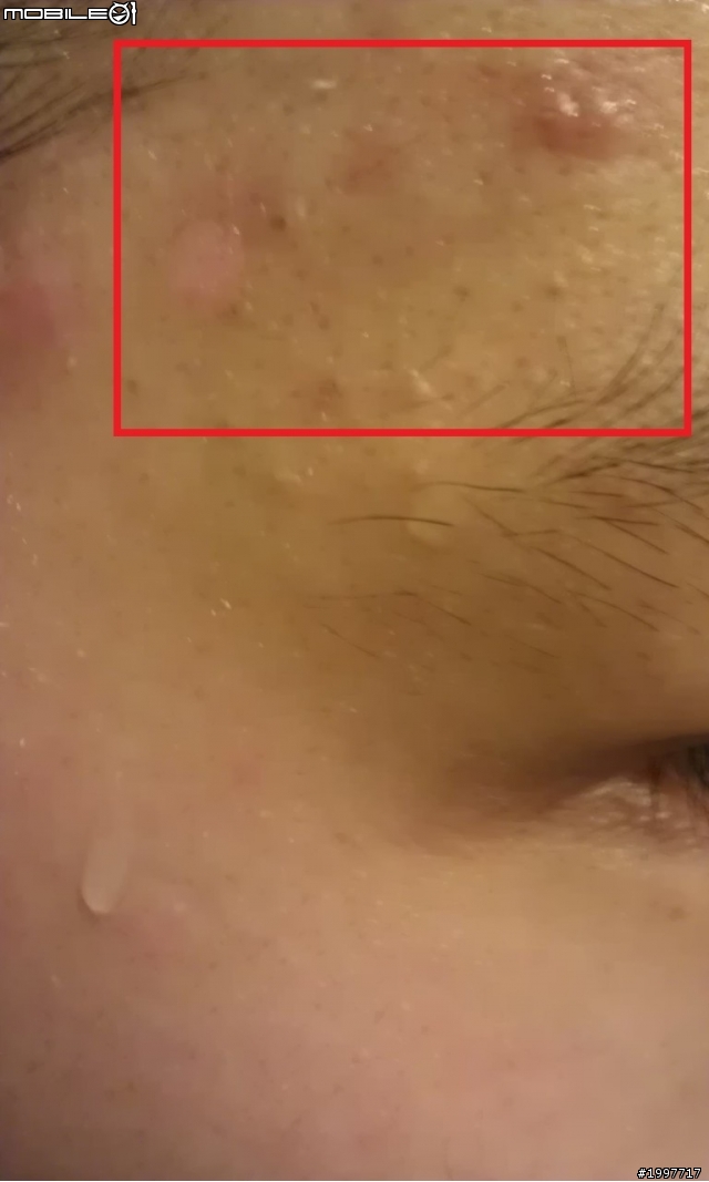 [心得] 男人的面子問題-與閃光的抗痘之戰