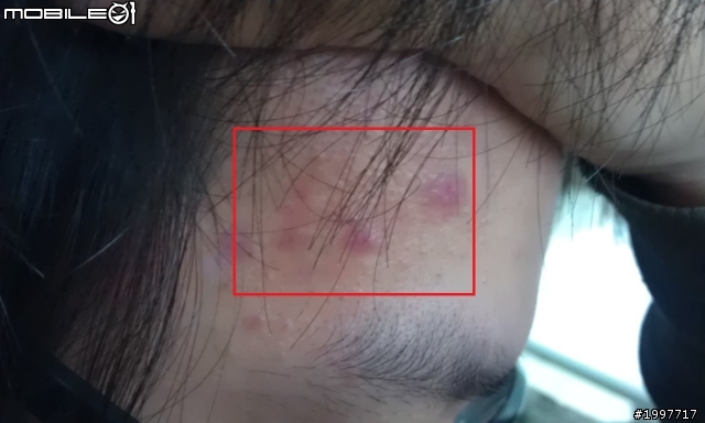 [心得] 男人的面子問題-與閃光的抗痘之戰